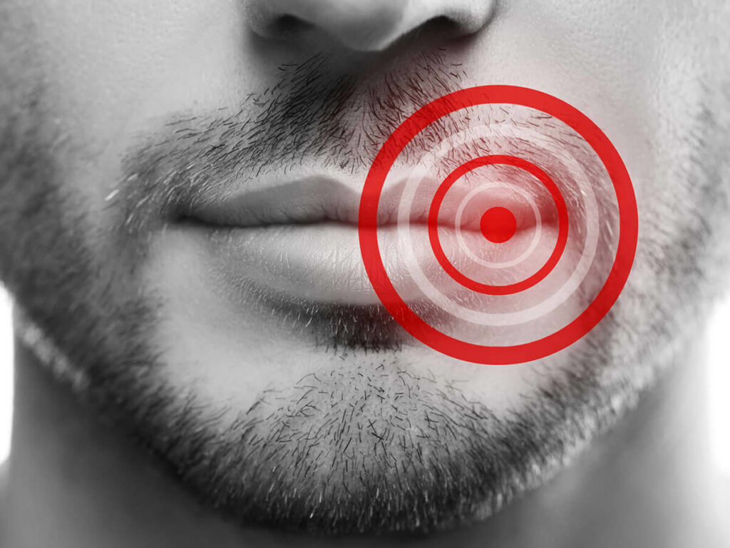 picture of lips with a target to signify a cold sore outbreak