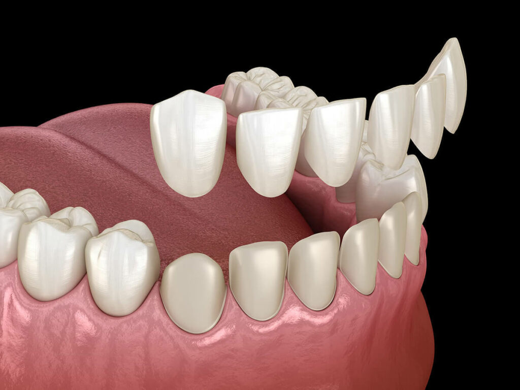 Porcelain Teeth Veneers