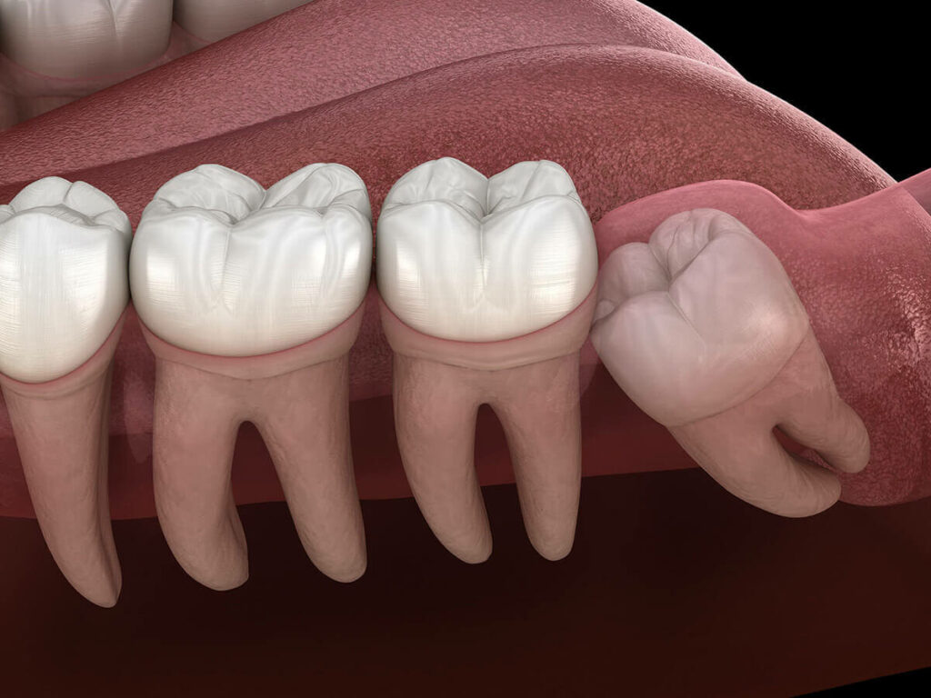 illustration of wisdom teeth in mouth